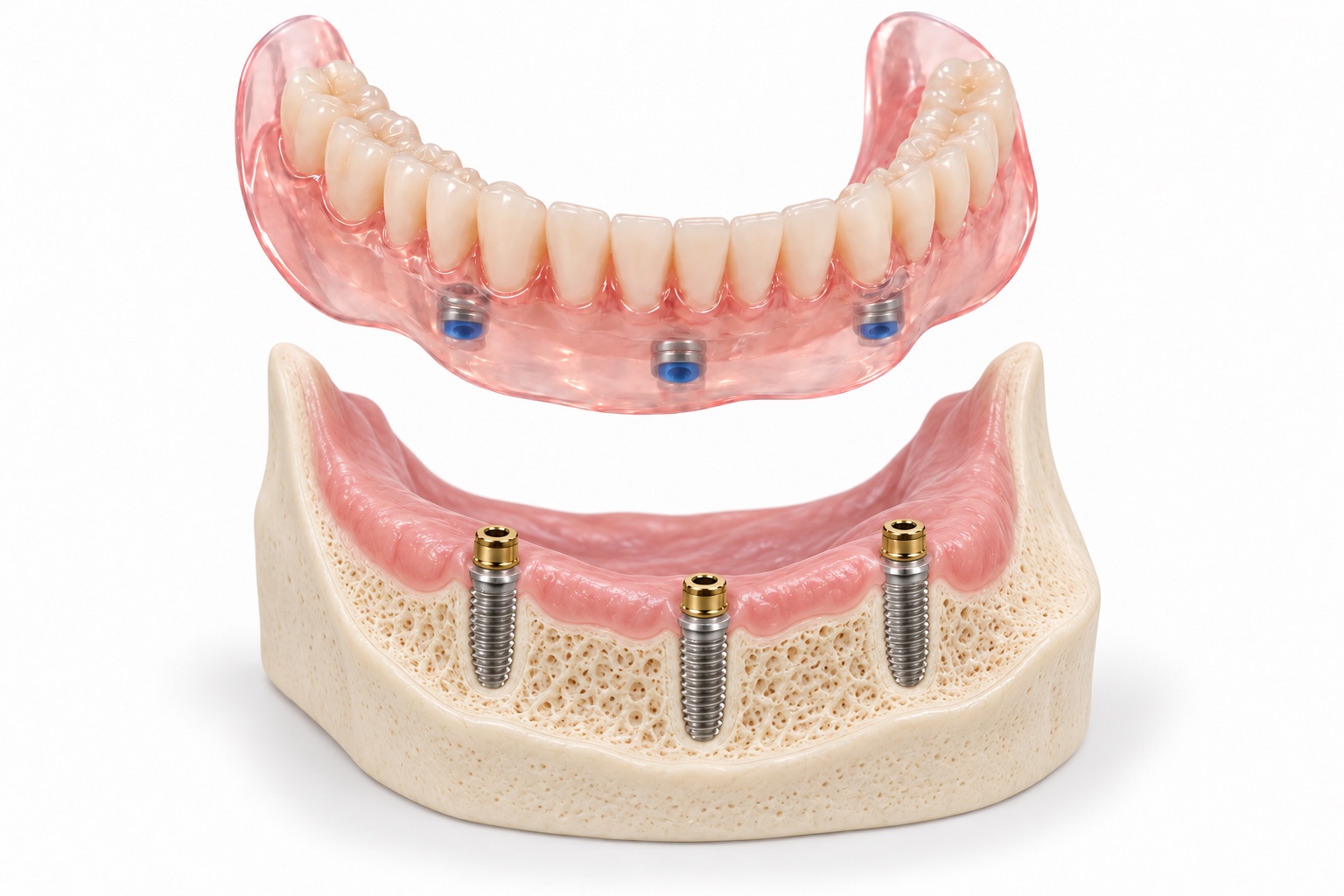 Snap-on denture and implant attachment model