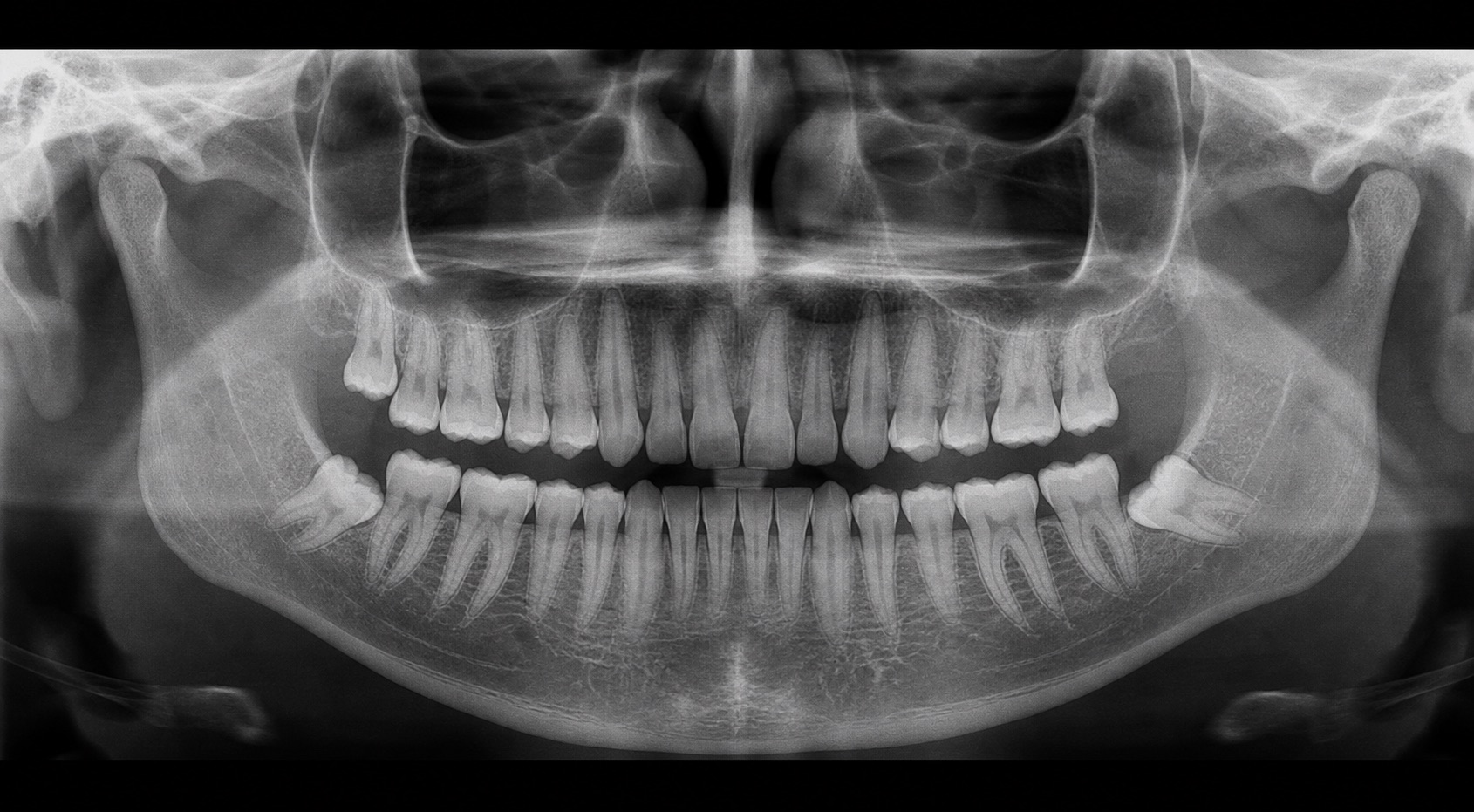 Panoramic dental X-ray showing impacted lower wisdom teeth